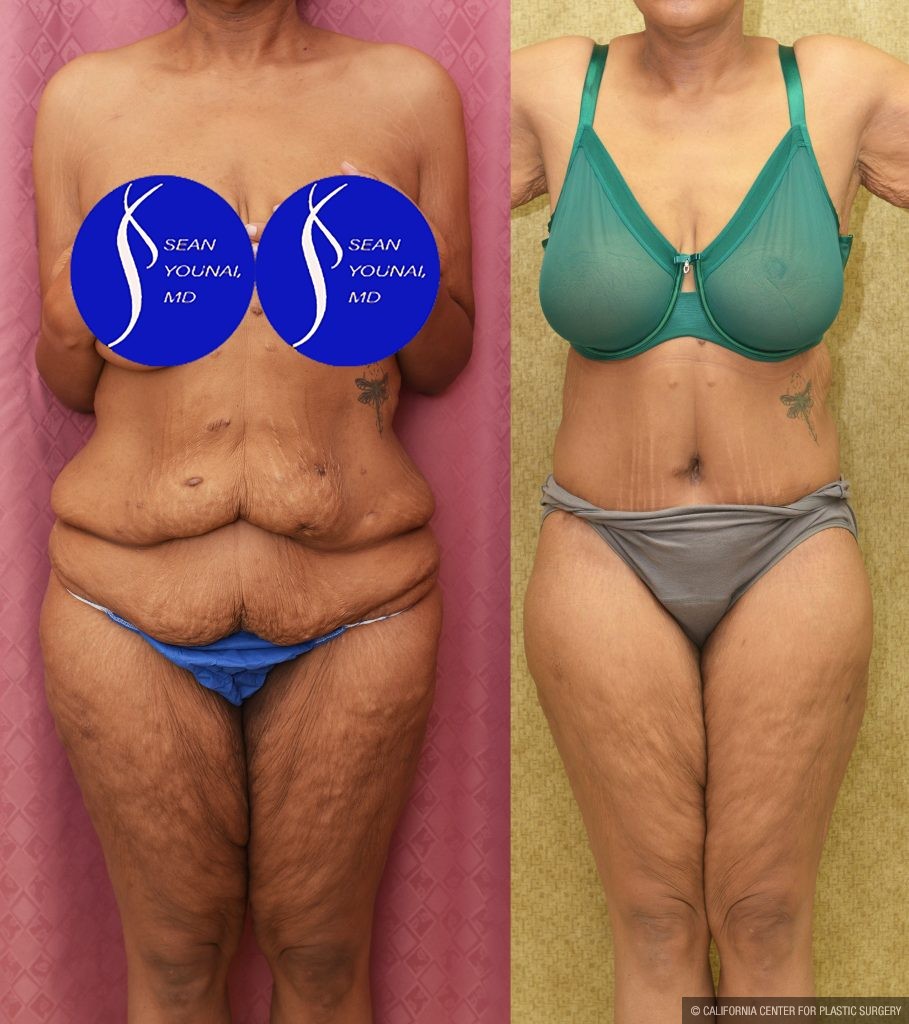 Tummy Tuck (Abdominoplasty) Plus Size Before & After Patient #13761