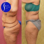 Tummy Tuck (Abdominoplasty) Plus Size Before & After Patient #13761