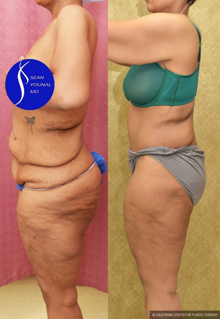 Tummy Tuck (Abdominoplasty) Plus Size Before & After Patient #13761