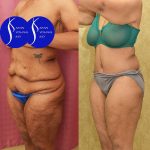 Tummy Tuck (Abdominoplasty) Plus Size Before & After Patient #13761