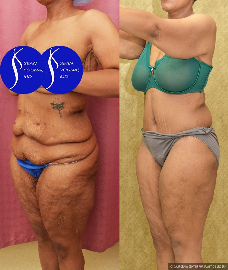 Tummy Tuck (Abdominoplasty) Plus Size Before & After Patient #13761