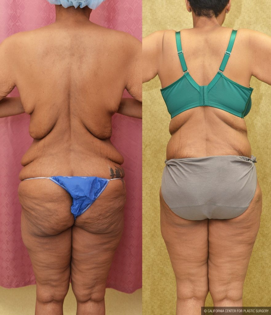 Tummy Tuck (Abdominoplasty) Plus Size Before & After Patient #13761