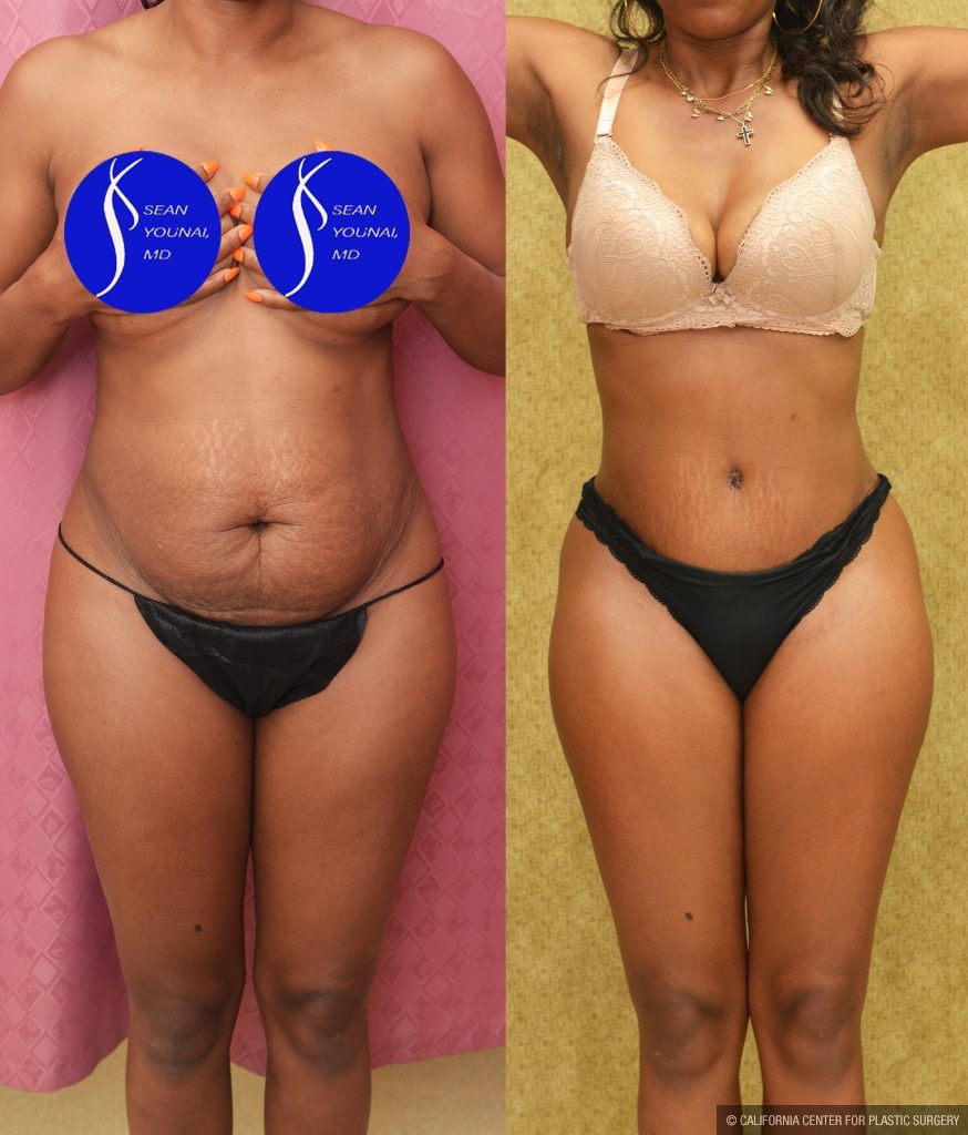 Tummy Tuck (Abdominoplasty) Small Size Before & After Patient #13762