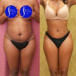 African American Tummy Tuck (Abdominoplasty) Before & After Patient #13760
