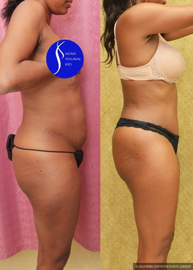 Tummy Tuck (Abdominoplasty) Small Size Before & After Patient #13762