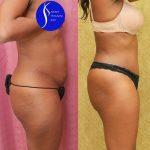 African American Tummy Tuck (Abdominoplasty) Before & After Patient #13760