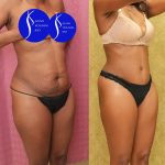 African American Tummy Tuck (Abdominoplasty) Before & After Patient #13760