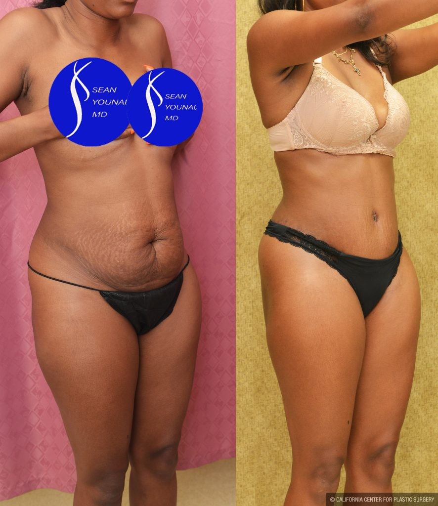 African American Tummy Tuck (Abdominoplasty) Before & After Patient #13760