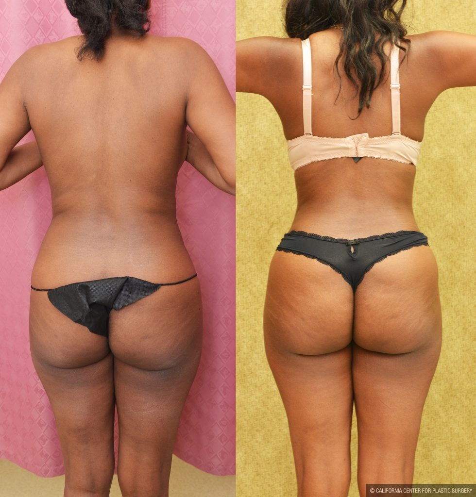 African American Tummy Tuck (Abdominoplasty) Before & After Patient #13760