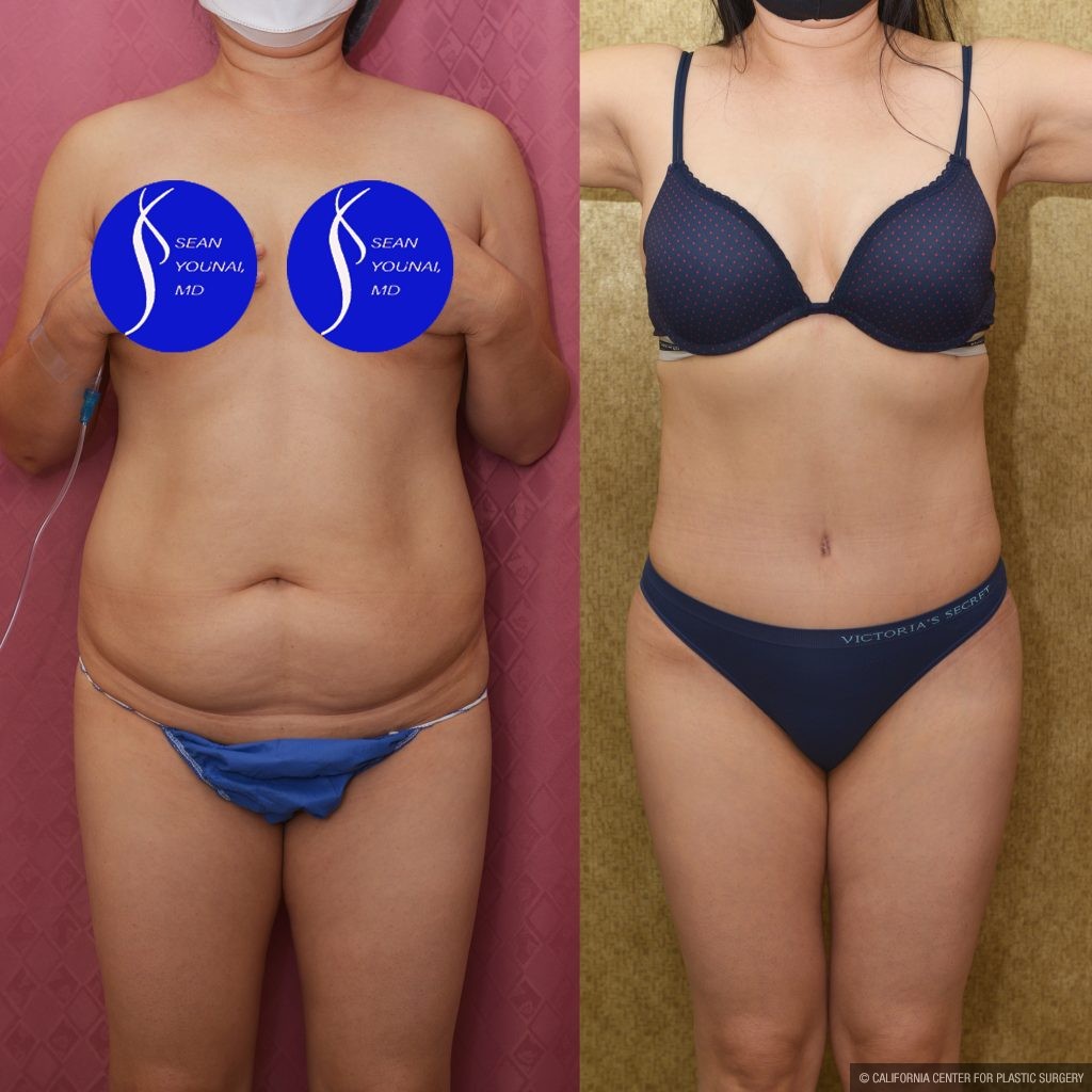Tummy Tuck (Abdominoplasty) Small Size Before & After Patient #13763