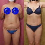 Tummy Tuck (Abdominoplasty) Small Size Before & After Patient #13763