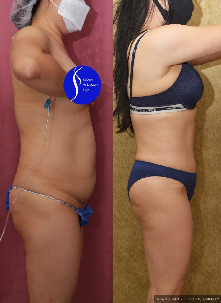 Tummy Tuck (Abdominoplasty) Small Size Before & After Patient #13763