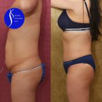 Tummy Tuck (Abdominoplasty) Small Size Before & After Patient #13763