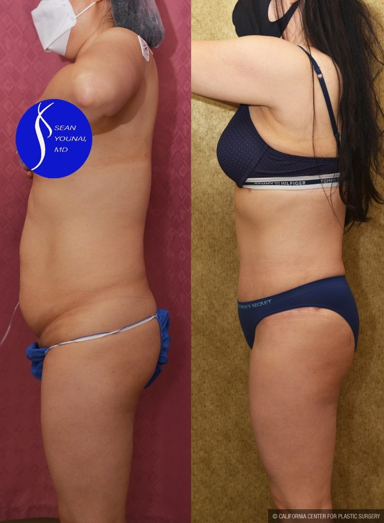 Tummy Tuck (Abdominoplasty) Small Size Before & After Patient #13763