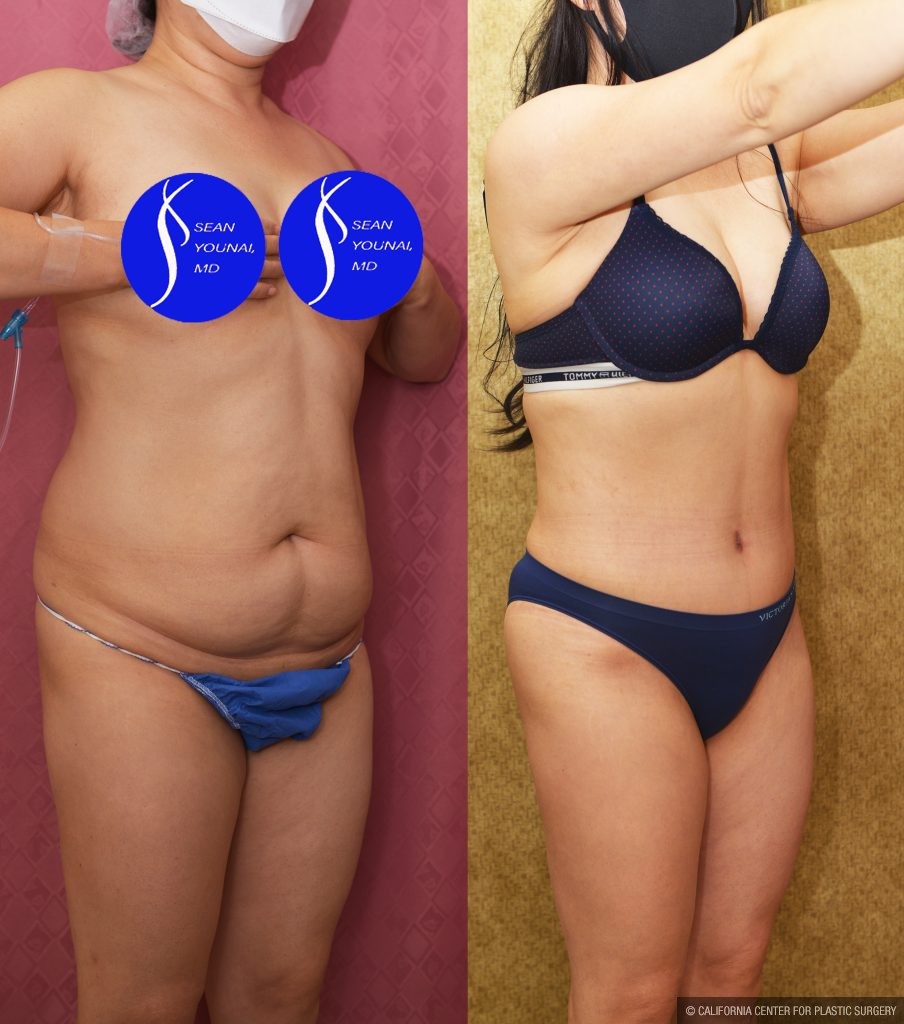 Tummy Tuck (Abdominoplasty) Small Size Before & After Patient #13763