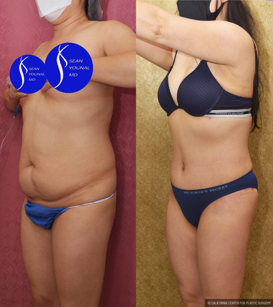 Tummy Tuck (Abdominoplasty) Small Size Before & After Patient #13763