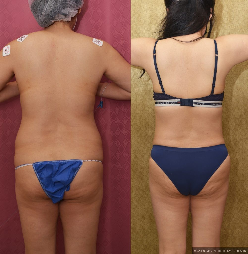 Tummy Tuck (Abdominoplasty) Small Size Before & After Patient #13763