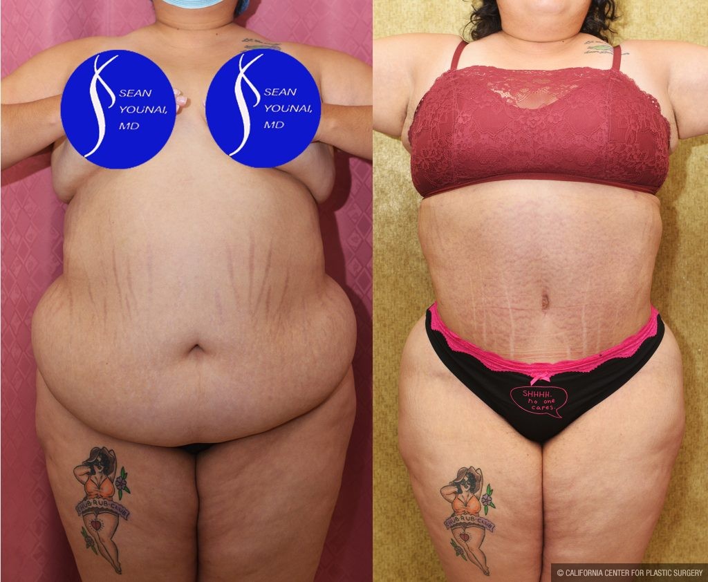 Tummy Tuck (Abdominoplasty) Super Plus Size Before & After Patient #13765