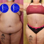 Tummy Tuck (Abdominoplasty) Super Plus Size Before & After Patient #13765