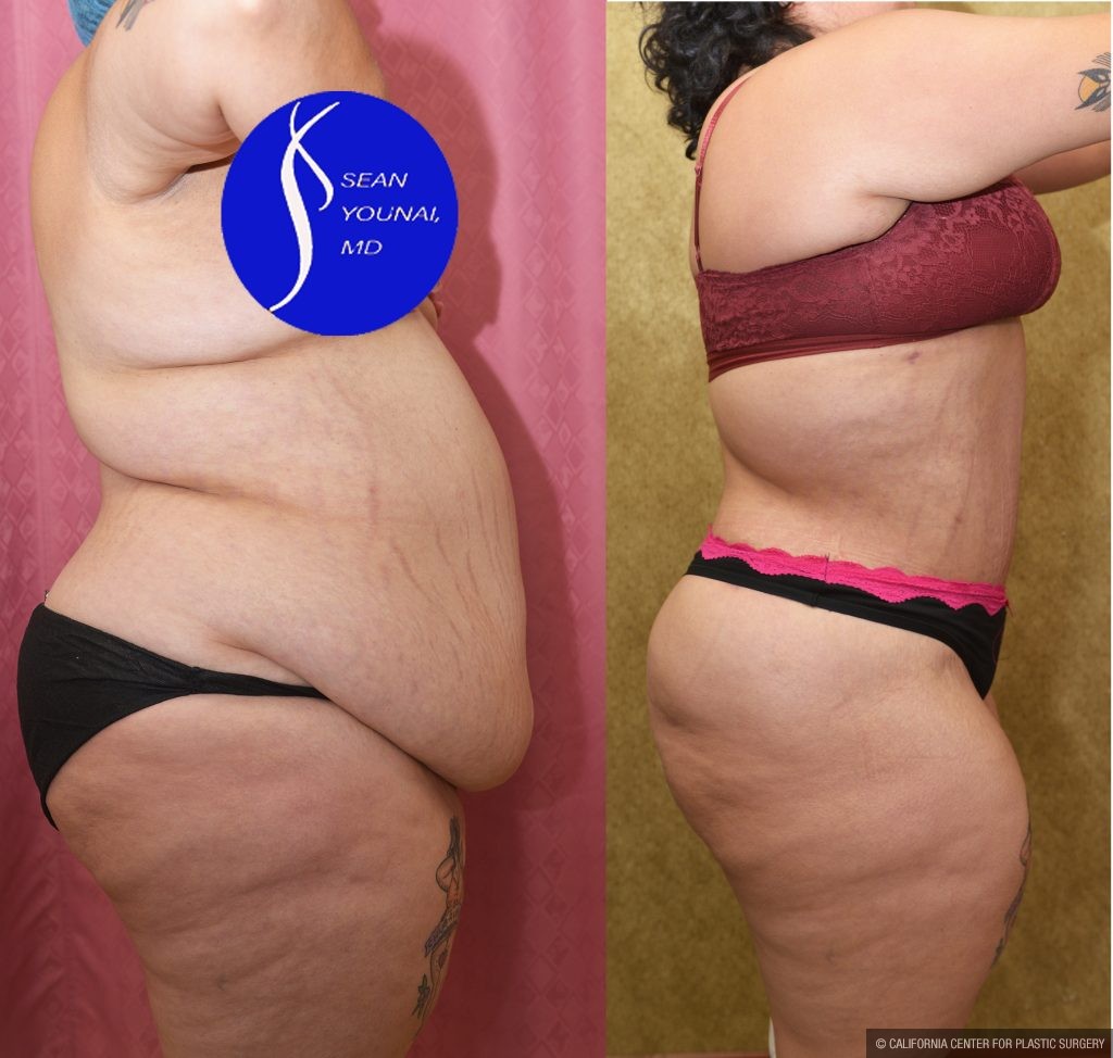 Tummy Tuck (Abdominoplasty) Super Plus Size Before & After Patient #13765