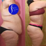 Tummy Tuck (Abdominoplasty) Super Plus Size Before & After Patient #13765