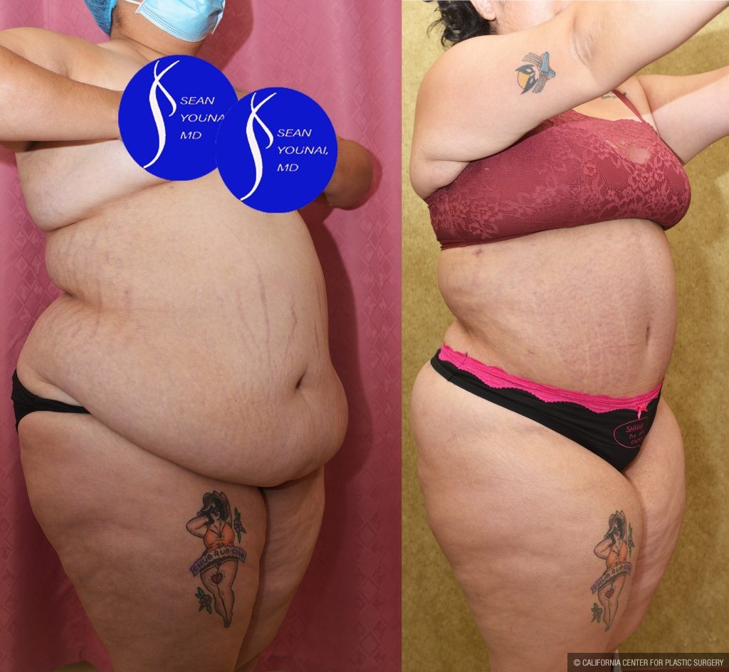 Tummy Tuck (Abdominoplasty) Super Plus Size Before & After Patient #13765