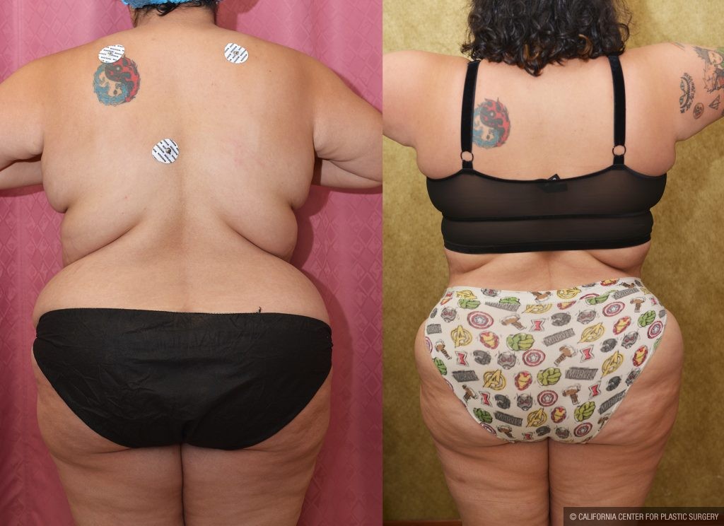 Tummy Tuck (Abdominoplasty) Super Plus Size Before & After Patient #13765