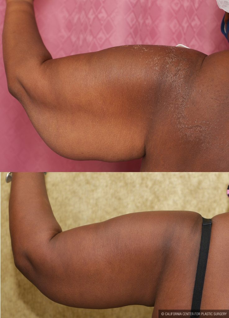 Arm Lift (Brachioplasty) Before & After Patient #13753
