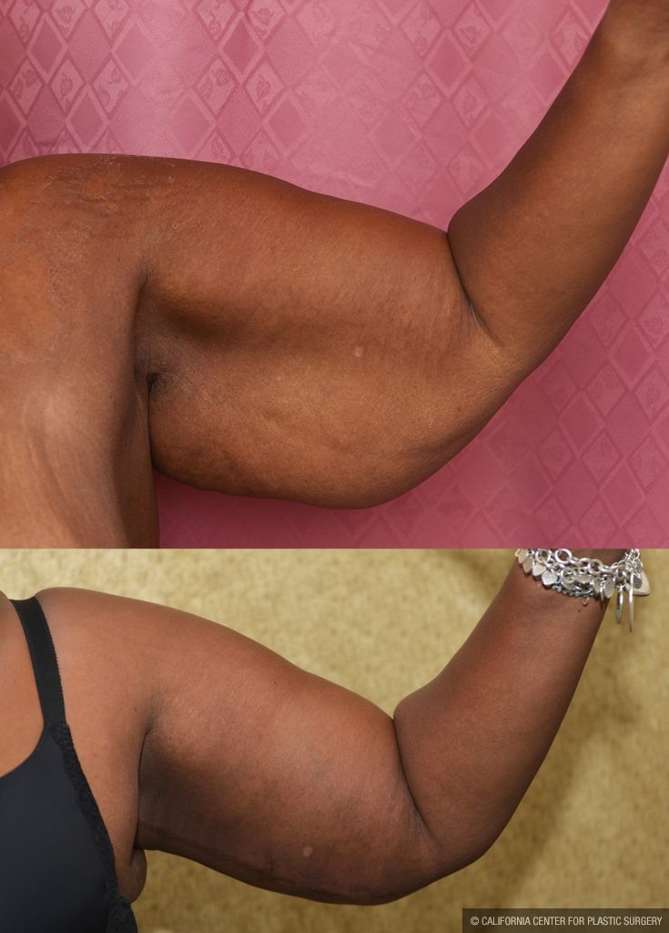 Arm Lift (Brachioplasty) Before & After Patient #13753