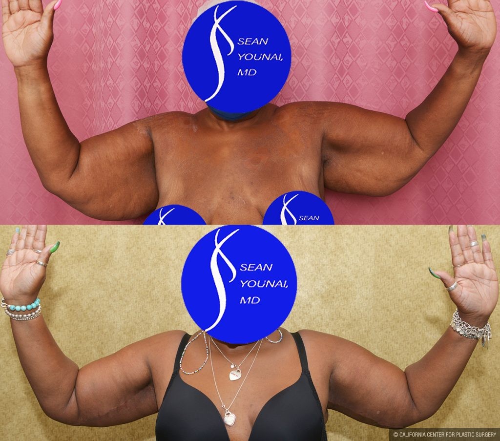 Arm Lift (Brachioplasty) Before & After Patient #13753