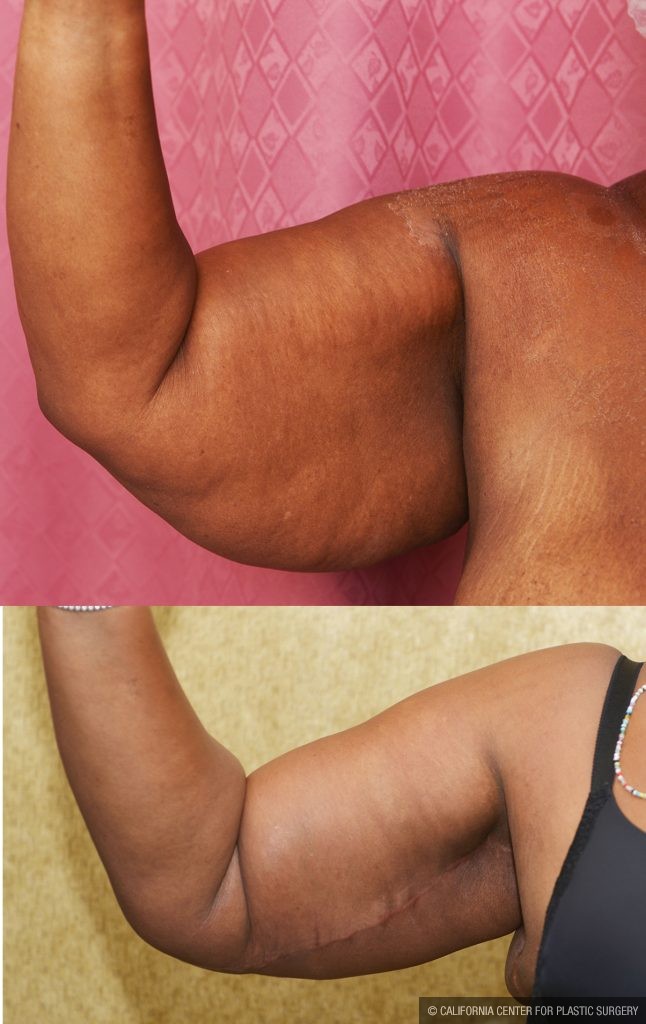 Arm Lift (Brachioplasty) Before & After Patient #13753