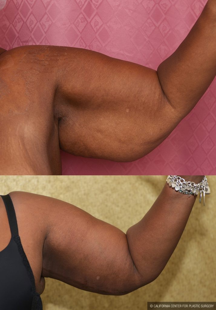 Arm Lift (Brachioplasty) Before & After Patient #13753