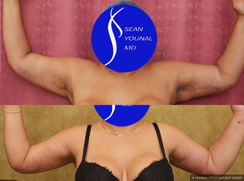 Arm Lift (Brachioplasty) Before & After Patient #13754