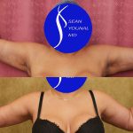 Arm Lift (Brachioplasty) Before & After Patient #13754