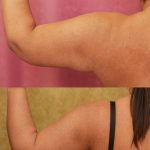 Arm Lift (Brachioplasty) Before & After Patient #13754