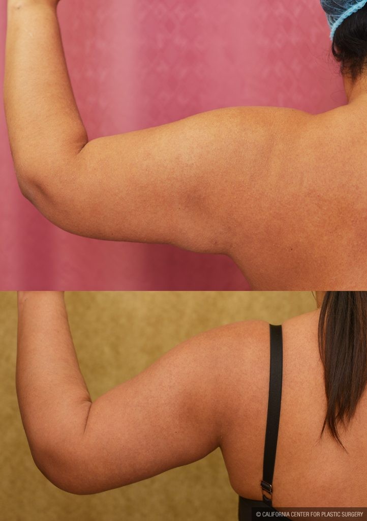 Arm Lift (Brachioplasty) Before & After Patient #13754