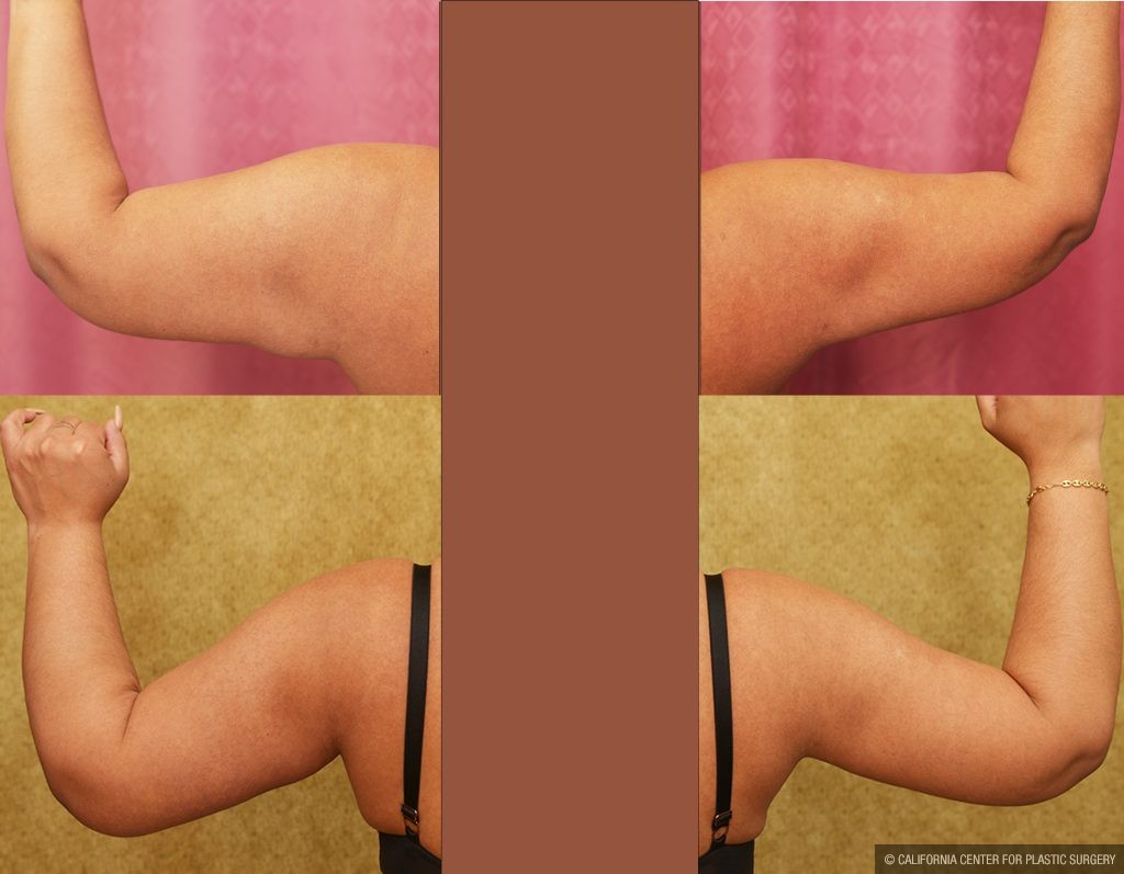 Arm Lift (Brachioplasty) Before & After Patient #13754