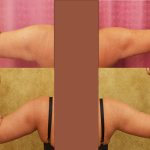 Arm Lift (Brachioplasty) Before & After Patient #13754