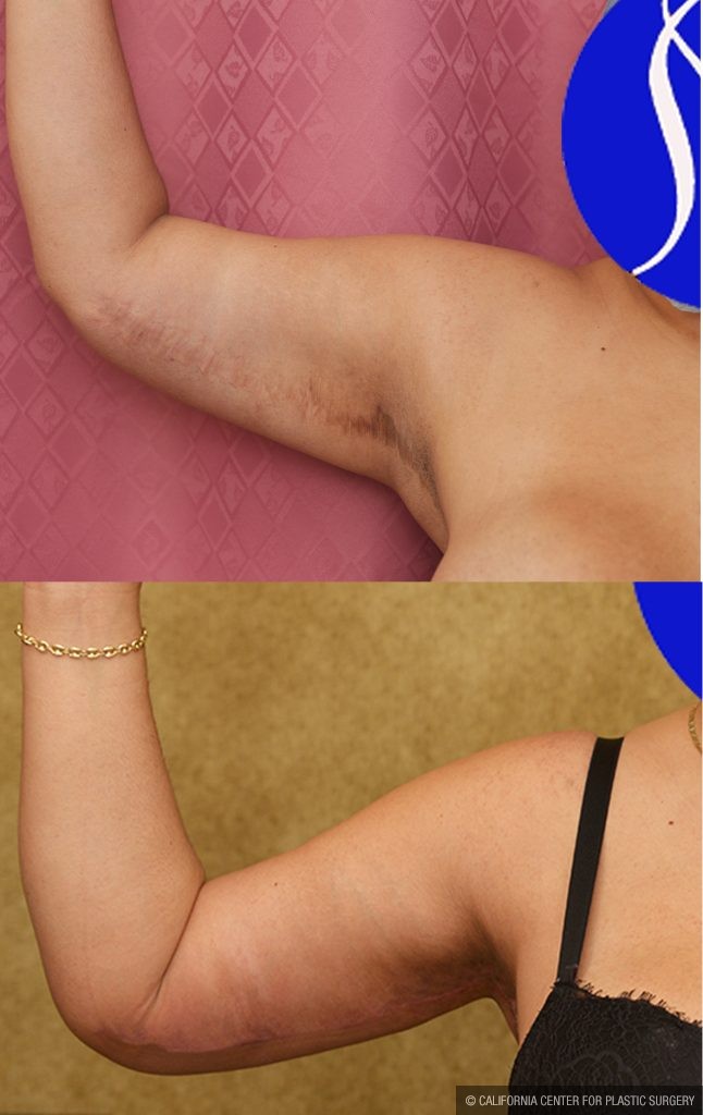 Arm Lift (Brachioplasty) Before & After Patient #13754