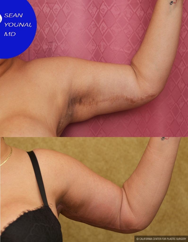 Arm Lift (Brachioplasty) Before & After Patient #13754
