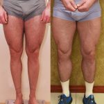 Calf Augmentation Before & After Patient #13757