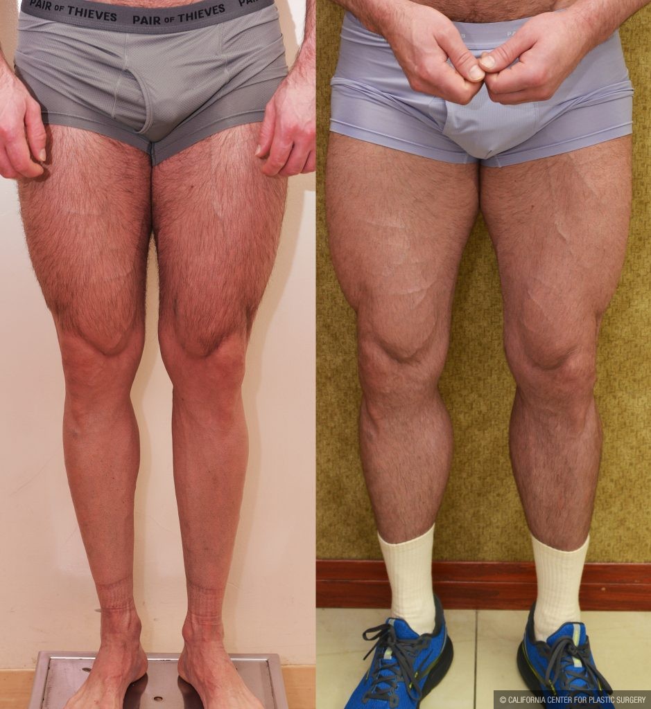 Calf Augmentation Before & After Patient #13757