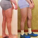 Calf Augmentation Before & After Patient #13757