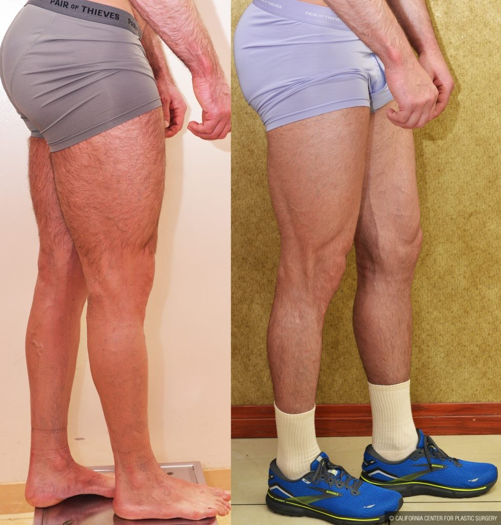 Calf Augmentation Before & After Patient #13757