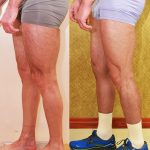 Calf Augmentation Before & After Patient #13757