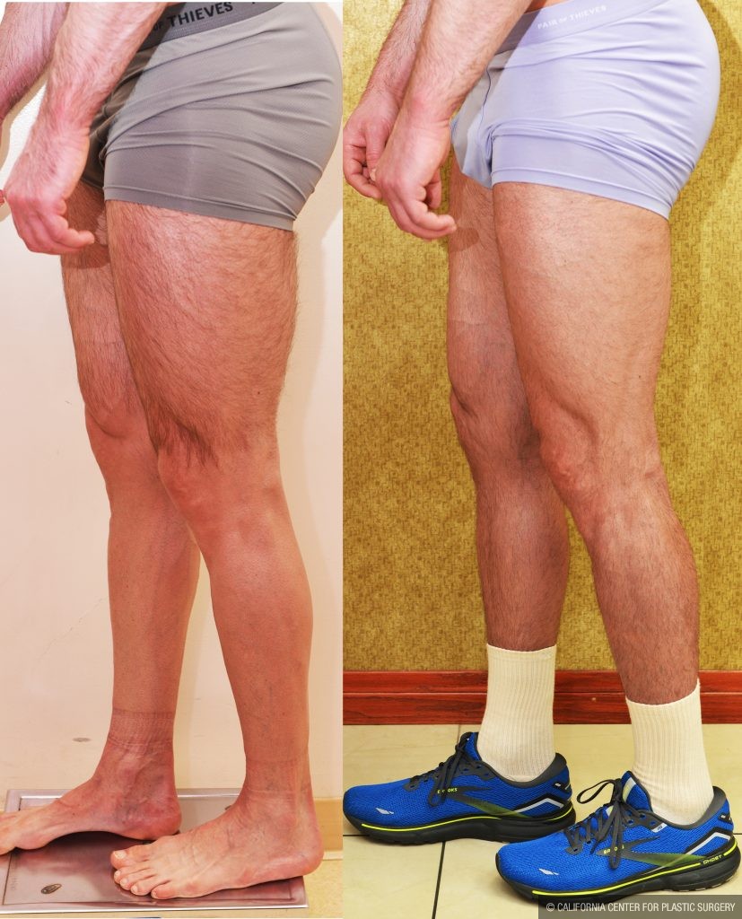 Calf Augmentation Before & After Patient #13757