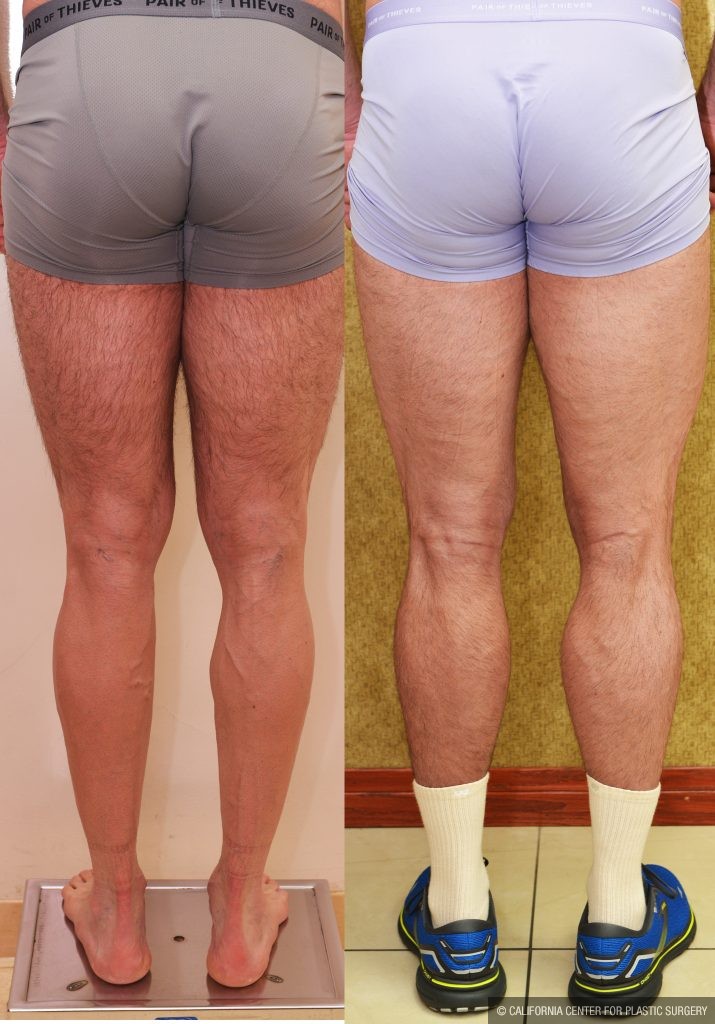 Calf Augmentation Before & After Patient #13757