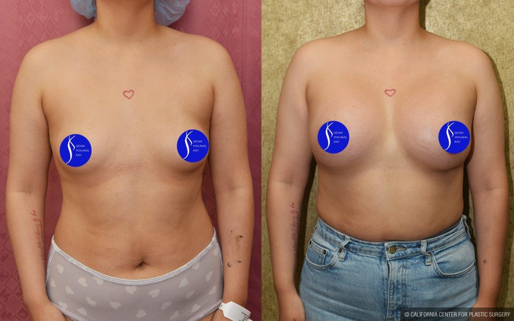 Breast Augmentation Before & After Patient #13866