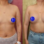 Breast Augmentation Before & After Patient #13866