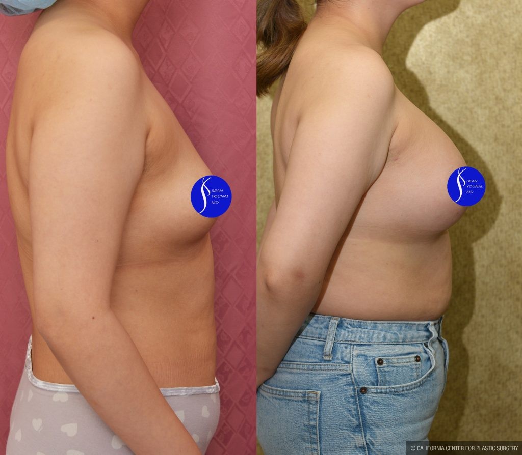 Breast Augmentation Before & After Patient #13866